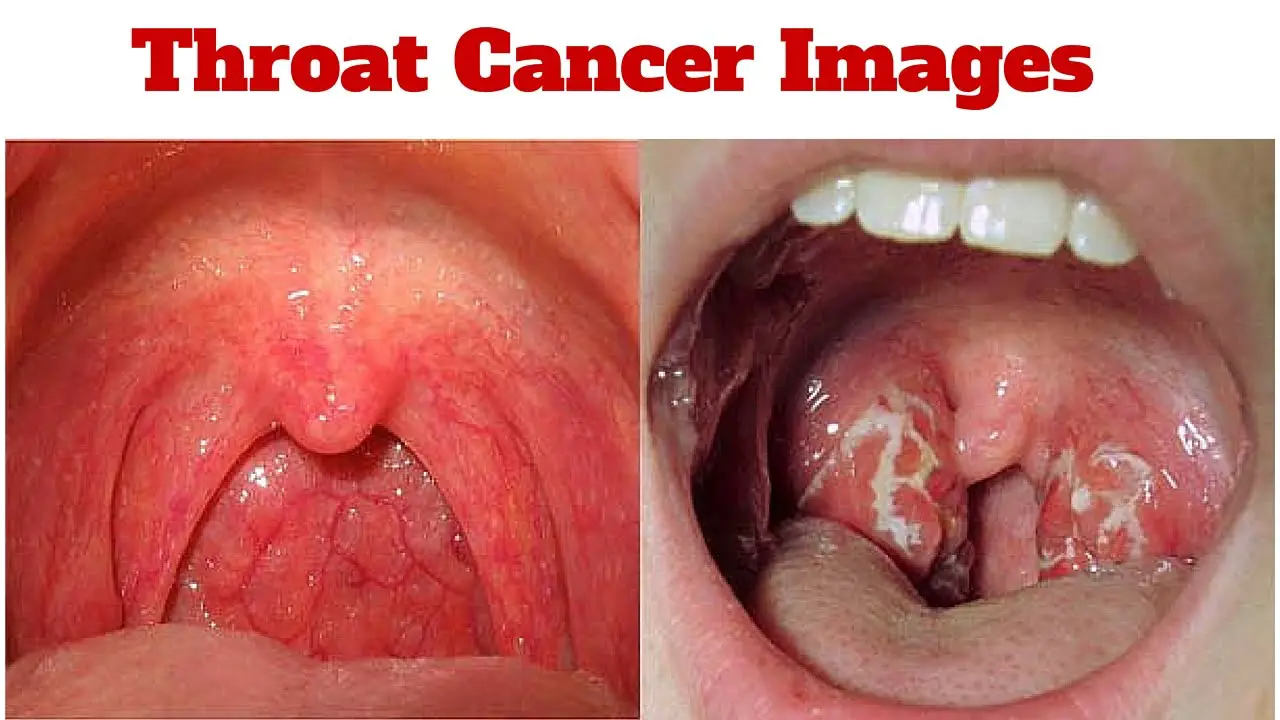 Hình ảnh bệnh nhân ung thư họng (bên phải).