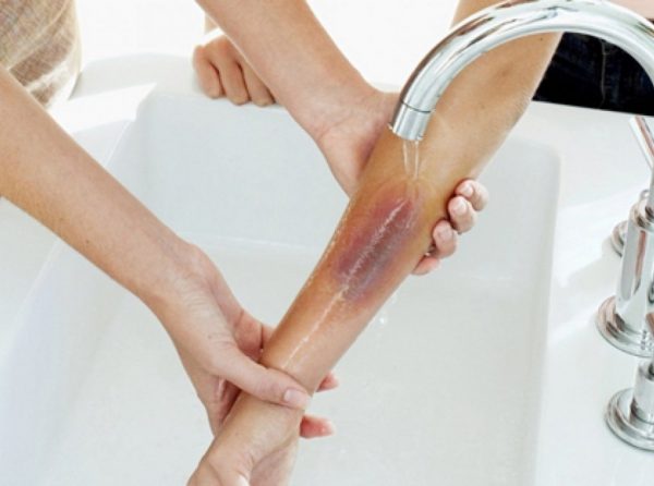 Nhanh chóng ngâm, rửa phần bị bỏng dưới vòi nước hoặc trong chậu nước mát.